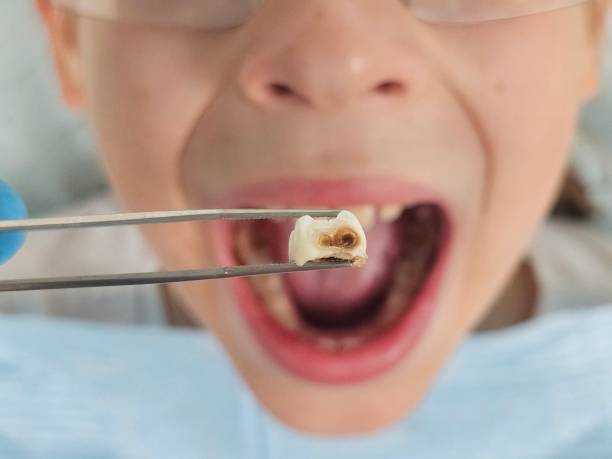 Best Emergency Tooth Extraction in Saranap, CA